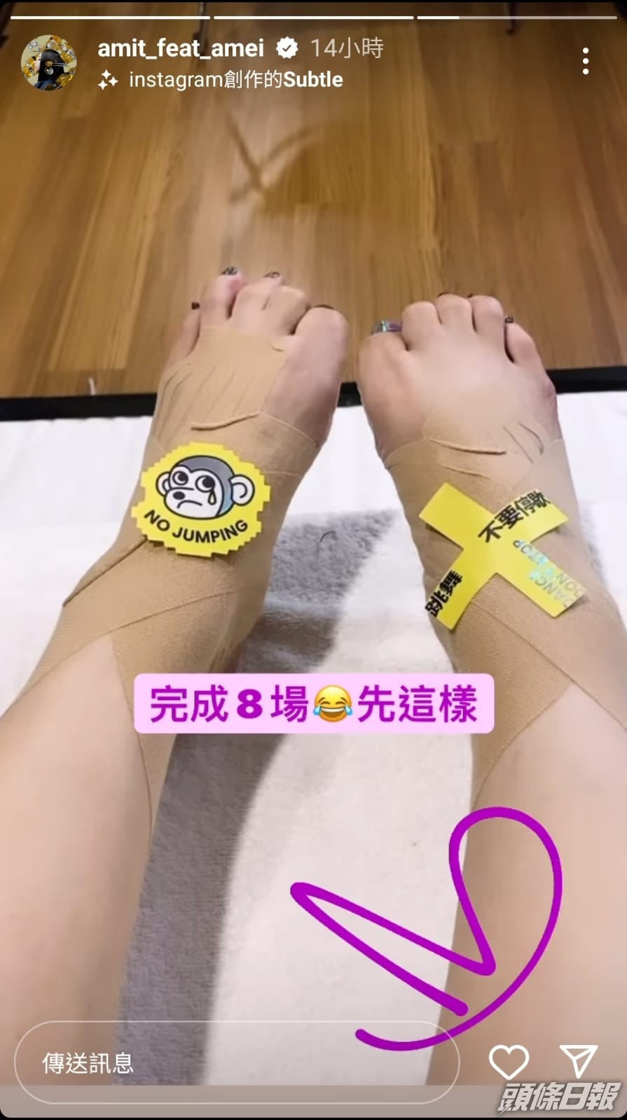 張惠妹雙腳唔止腫,睇落仲好傷吓。